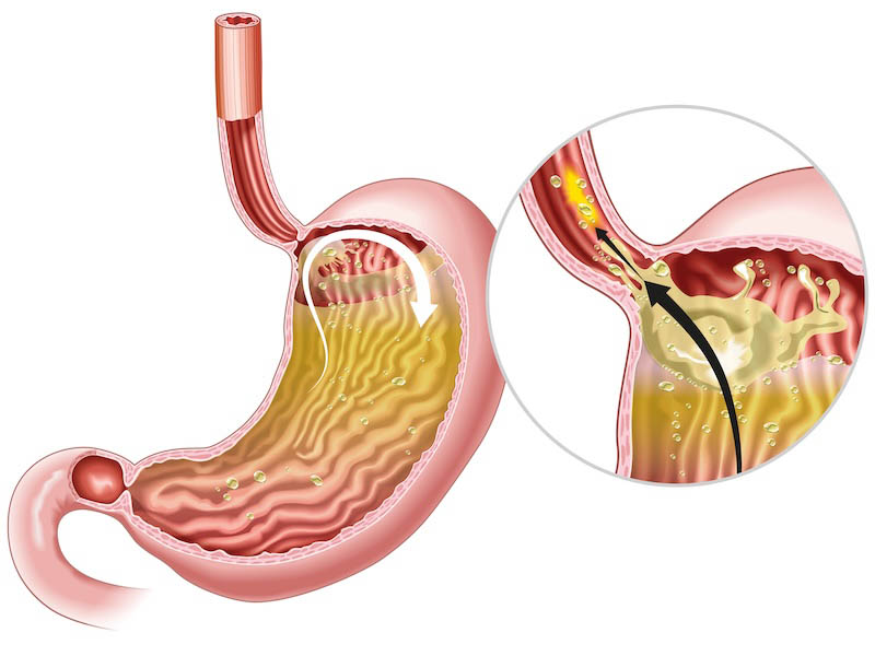 >Causes of GERD