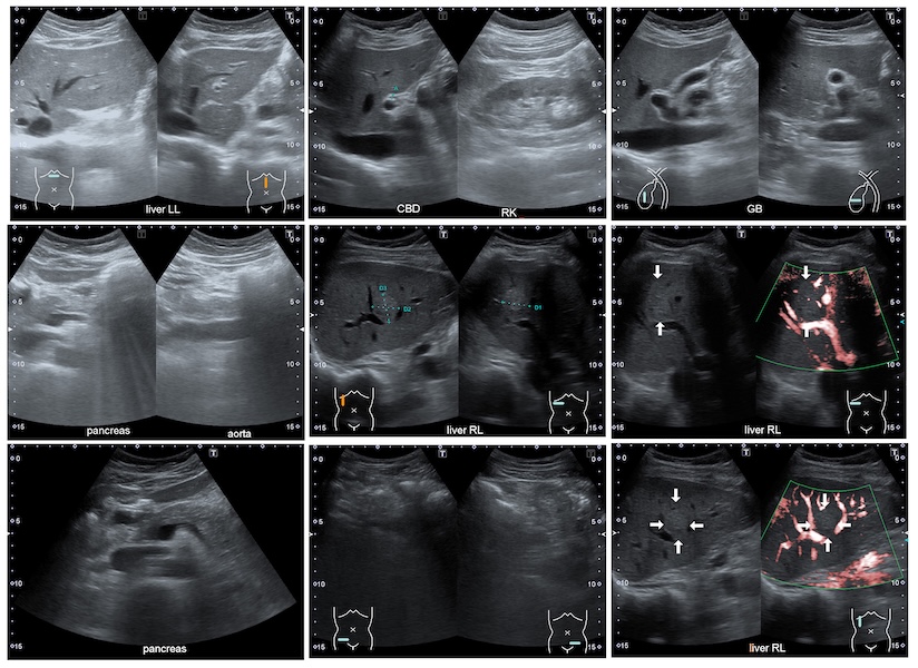 >Bile Duct & Pancreas