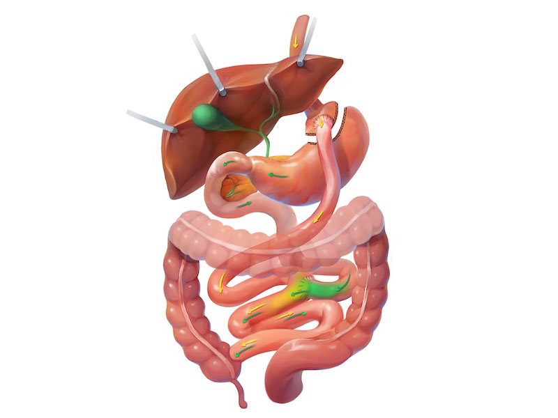>Gastric Bypass