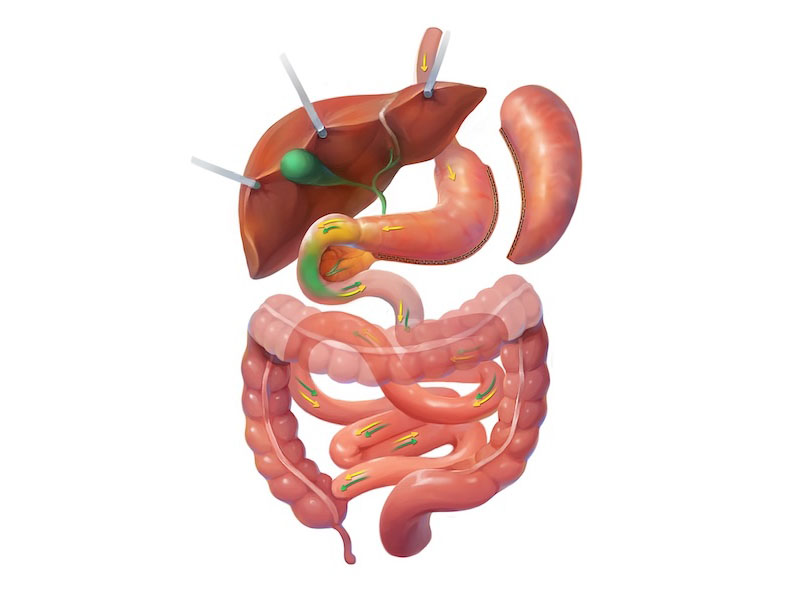 >Gastric Sleeve