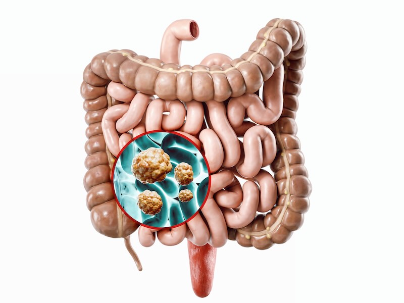 >Small Intestine Tumors