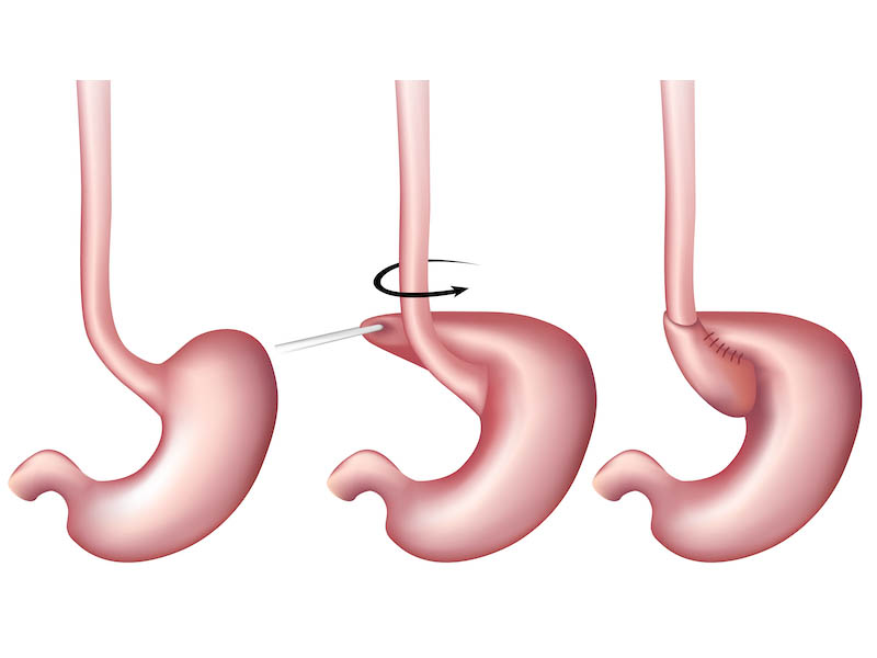 >Laparoscopic Fundoplication Surgery