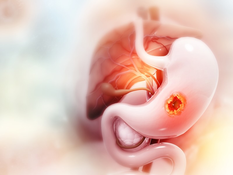 >About Peptic Ulcer Disease