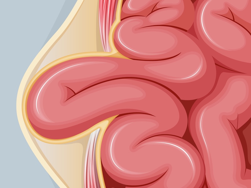 >Why Hernias Need to Be Taken Seriously