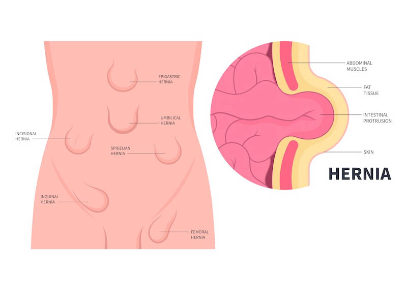 >Symptoms of a Hernia