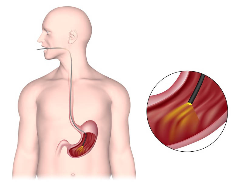 >Testing Before GERD Surgery