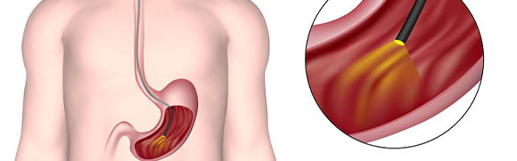 Upper GI Illustration